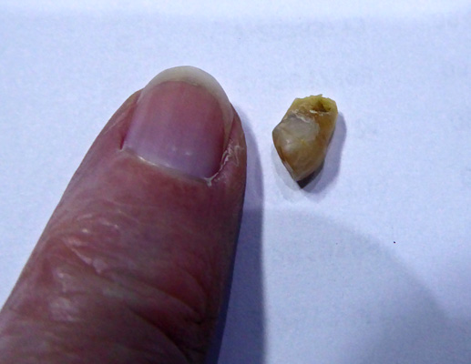 65 year old baby tooth